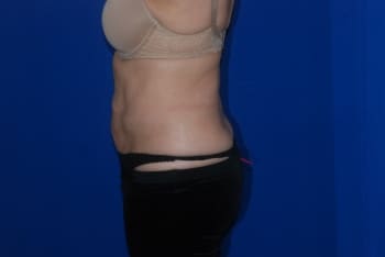 After Image: Liposuction - left-side