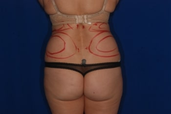 Before Image: Liposuction - back