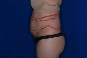 Before Image: Liposuction - left-side