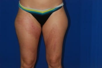 Before Image: Liposuction - front