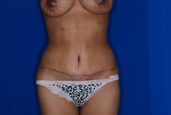After Image: Mommy Makeover - front