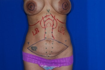 Before Image: Mommy Makeover - front