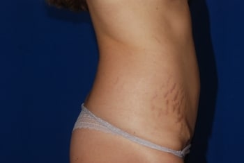 After Image: Mommy Makeover - right-side