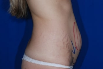 Before Image: Mommy Makeover - right-side