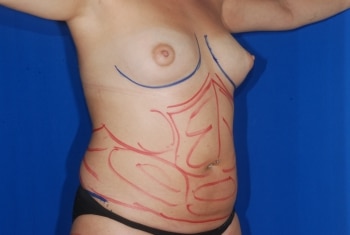 Before Image: Mommy Makeover - right-front-oblique