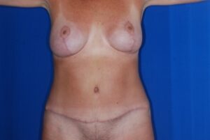 Tummy Tuck – Full Abdominoplasty