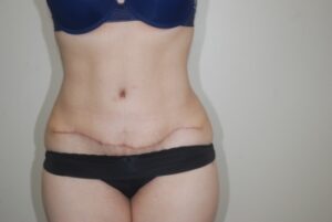 After Image: Tummy Tuck