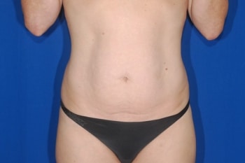 Before Image: Tummy Tuck2 - front