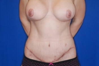 After Image: Tummy Tuck3 - front