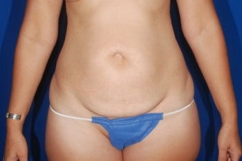 Before Image: Tummy Tuck4 - front