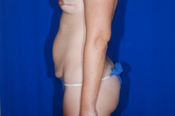 Before Image: Tummy Tuck4 - left-side