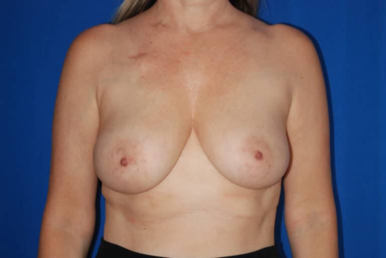 Before Image: Breast Reconstruction - front