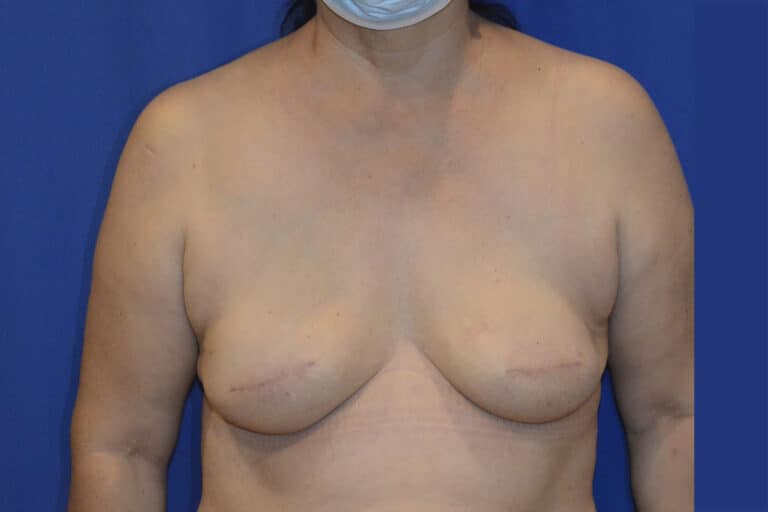 After Image: Breast Reconstruction - front