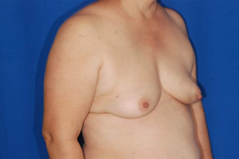 Before Image: Breast Reconstruction - right-front-oblique