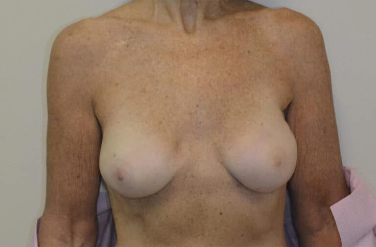 After Image: Breast Reconstruction - front