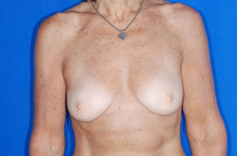 Before Image: Breast Reconstruction - front