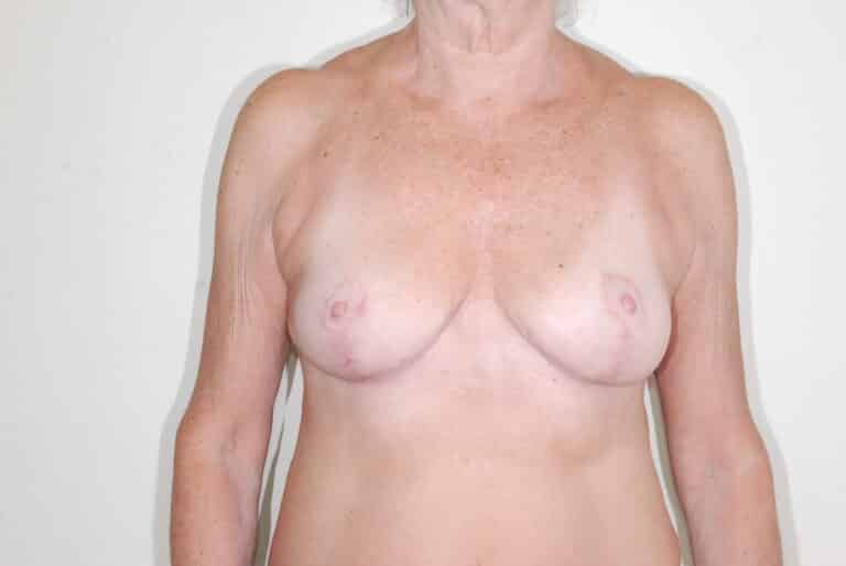 After Image: Breast Reduction - front