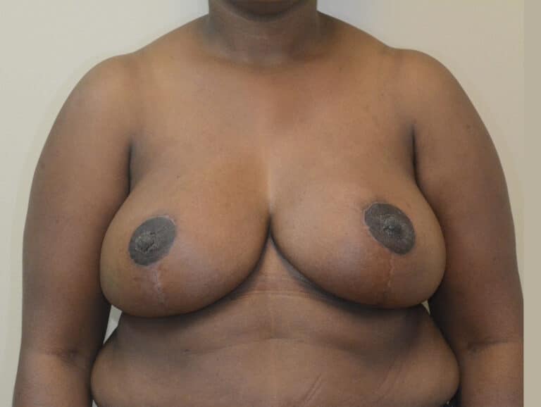 After Image: Breast Reduction - front