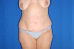 Before Image: Mommy Makeover