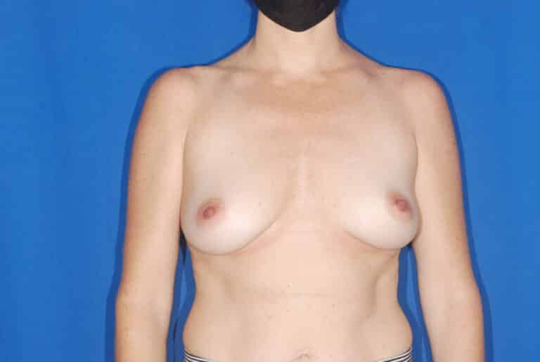 Before Image: Breast Reconstruction - front