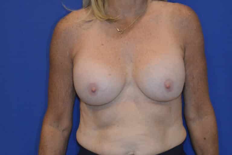 After Image: Breast Implant Revision - front