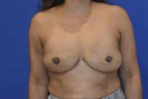 Breast Implant Revision – Explant