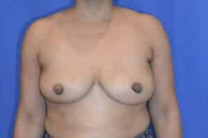 Breast Implant Revision – Explant