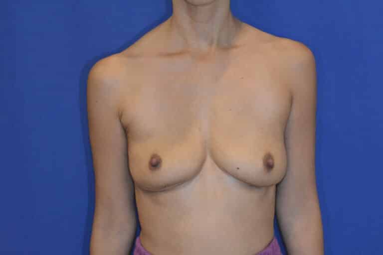 After Image: Breast Implant Revision – Explant - front