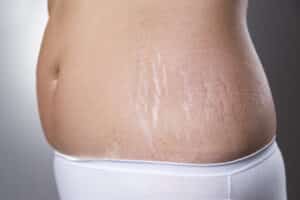 Woman with belly fat before mommy makeover in Boca Raton