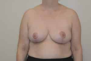 After Image: Breast Reduction