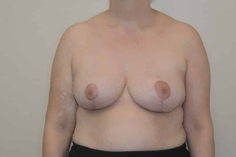 After Image: Breast Reduction - front