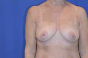 Before Image: Breast Augmentation