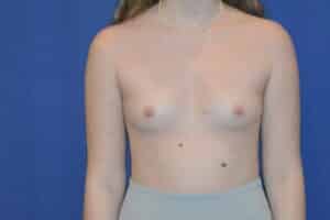 Before Image: Breast Augmentation