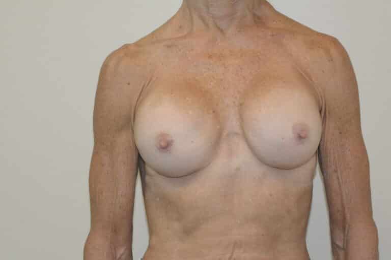 After Image: Breast Implant Revision - front