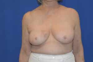 Before Image: Breast Reconstruction