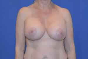 After Image: Breast Augmentation