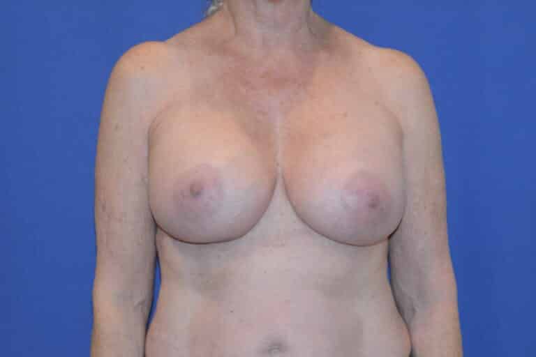 After Image: Breast Augmentation - front