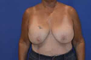 Before Image: Breast Implant Revision – Reaugmentation and Lift