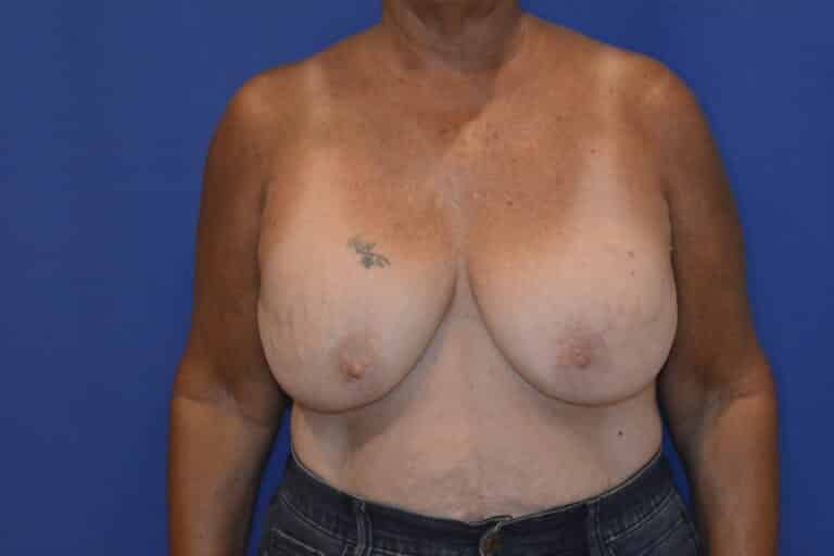 Before Image: Breast Implant Revision – Reaugmentation and Lift - front