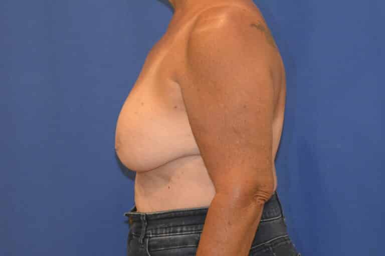 Before Image: Breast Implant Revision – Reaugmentation and Lift - left-side