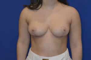 After Image: Breast Reduction