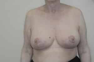 After Image: Breast Reduction