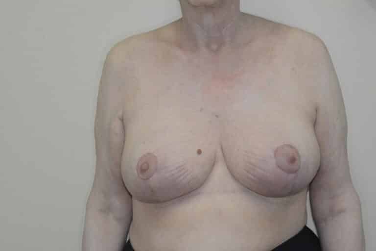 After Image: Breast Reduction - front
