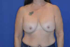 Before Image: Breast Implant Revision – Reaugmentation and Lift