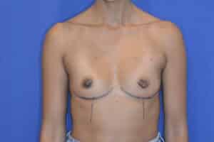 Before Image: Breast Augmentation