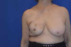 After Image: Breast Reconstruction