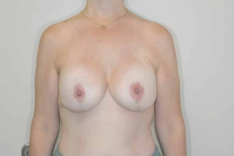 After Image: Breast Reconstruction - front