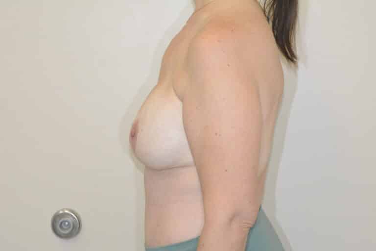 After Image: Breast Reconstruction - left-side