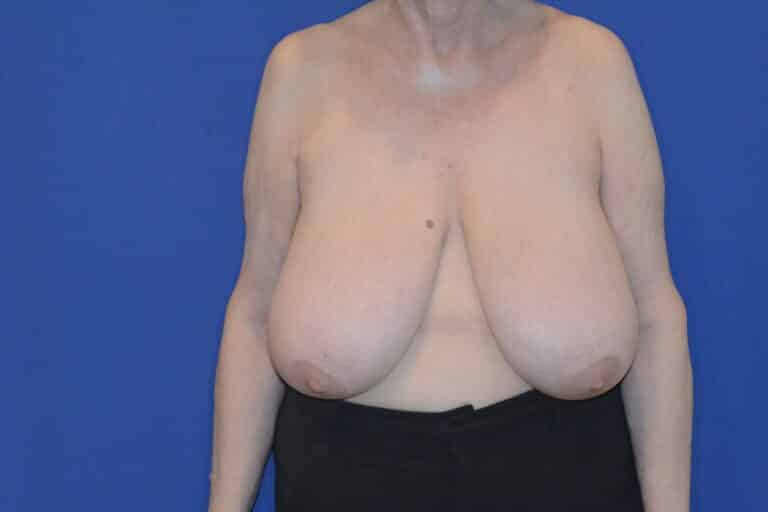 Before Image: Breast Reduction - front