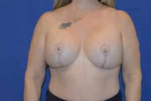 After Image: Breast Implant Revision – Reaugmentation and Lift
